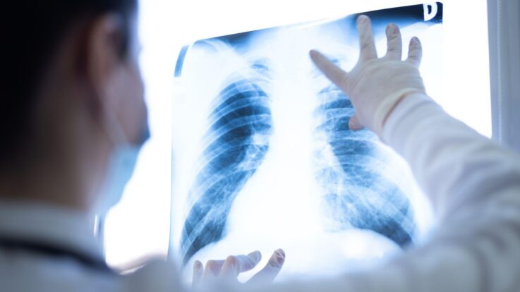 Lung Cancer & The Importance of Regular Screening