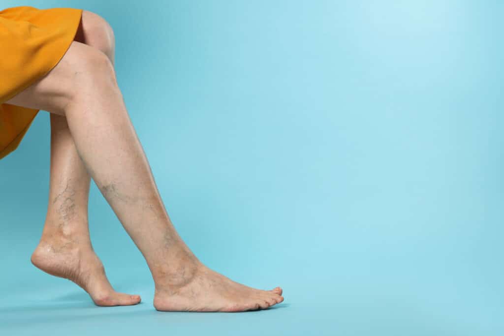 A person’s leg with varicose veins in front of a light blue background in El Paso.