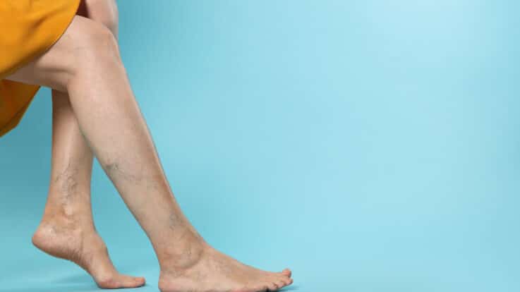 The Importance of Early Detection and Intervention in Varicose Vein Management
